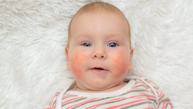 حساسية عسل النحل عند الأطفال وطرق العلاج