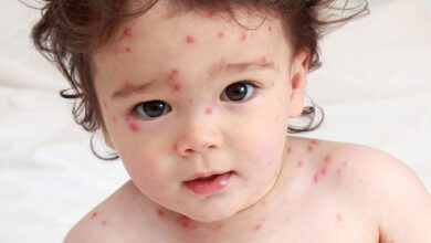مرض الجدري المائي أعراضة وطرق علاجه