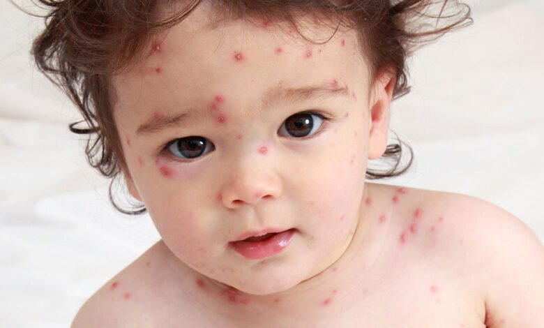 مرض الجدري المائي أعراضة وطرق علاجه