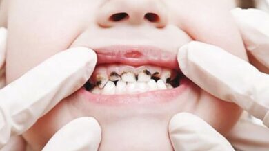 اكلات للاطفال تكافح تسوس الاسنان