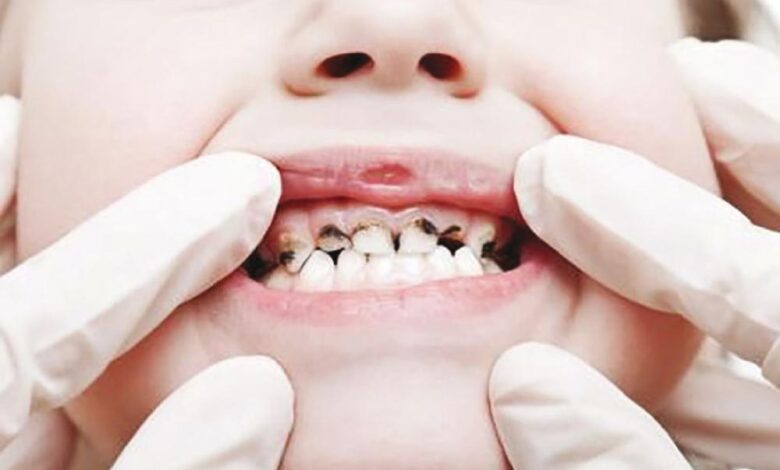 اكلات للاطفال تكافح تسوس الاسنان