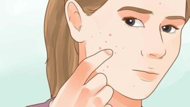 بالصور طريقة علاج اثار حب الشباب