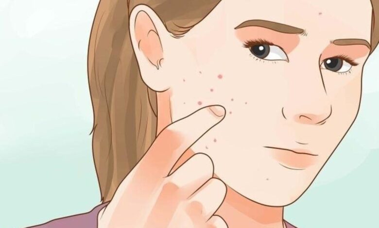بالصور طريقة علاج اثار حب الشباب