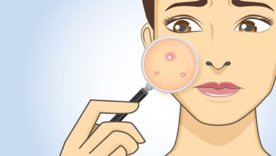 علاج حب الشباب و اللطع و البقع الجلدية