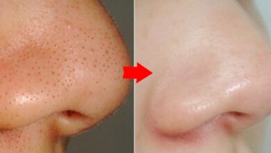 طرق للتخلص من الرؤوس السوداء
