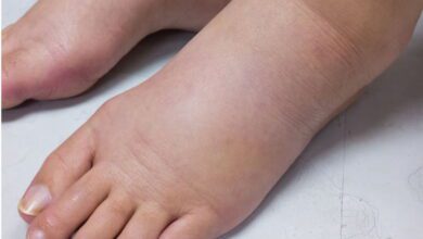 تعرفى على مرض التهاب الاوعية الليمفاوية